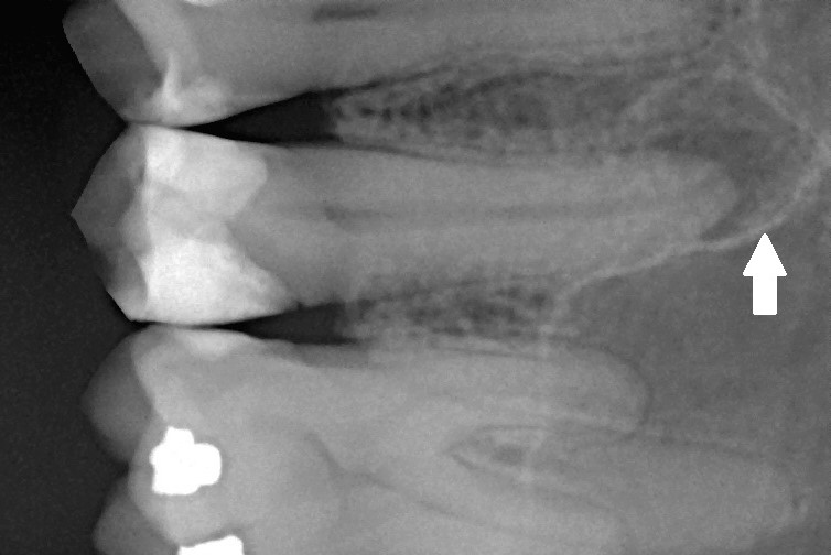 Gum disease progresses slowly over a period of 20 to 30 years before the teeth are lost. Michele Gardini/Wikimedia