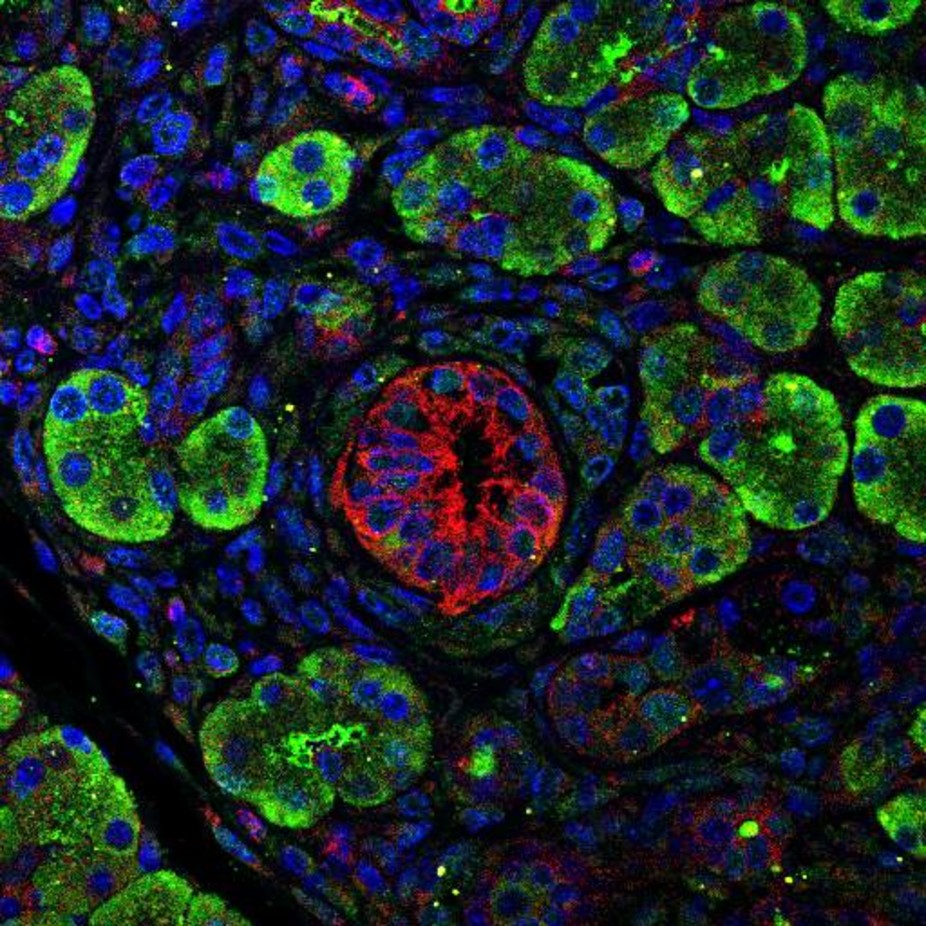 Fluorescence microscopy image of the early stages of pancreatic cancer. Author provided